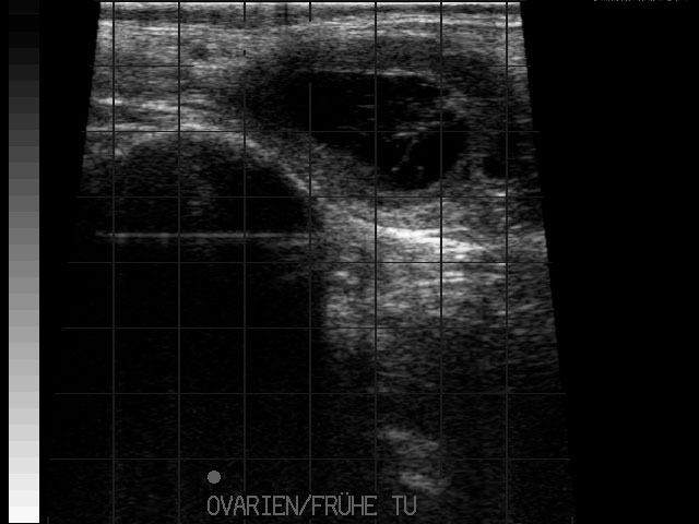 Ultraschallbild &ndash; GK Zyste 2