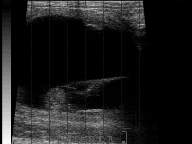 Ultraschallbild &ndash; Resorption Sp&auml;t