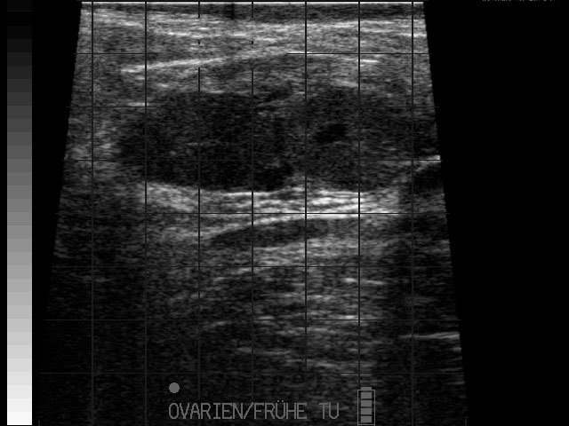 Ultraschallbild &ndash; Zwei GK